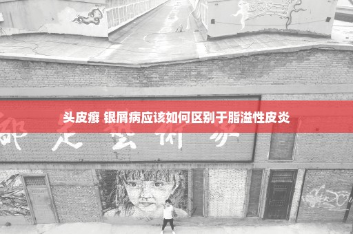 头皮癣 银屑病应该如何区别于脂溢性皮炎