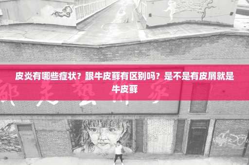 皮炎有哪些症状？跟牛皮藓有区别吗？是不是有皮屑就是牛皮藓