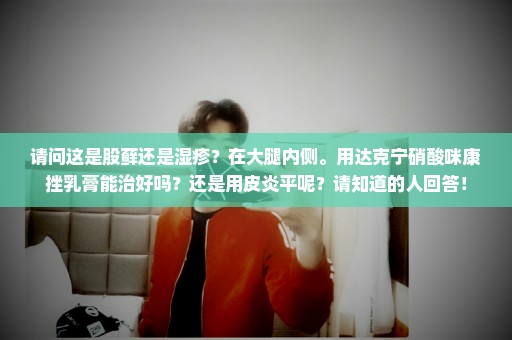请问这是股藓还是湿疹？在大腿内侧。用达克宁硝酸咪康挫乳膏能治好吗？还是用皮炎平呢？请知道的人回答！